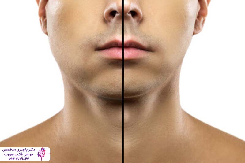 ورم صورت بعد از پیوند استخوان