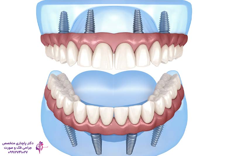 ایمپلنت دندان برای کودکان