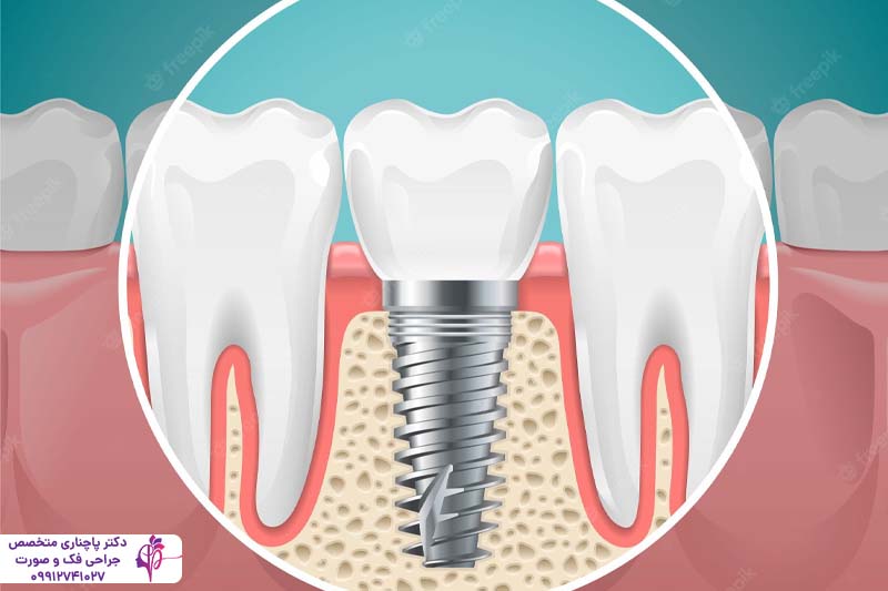 کاشت مجدد ایمپلنت دندان