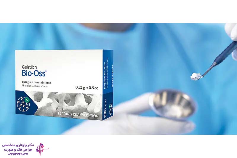 بهترین پودر استخوان برای ایمپلنت