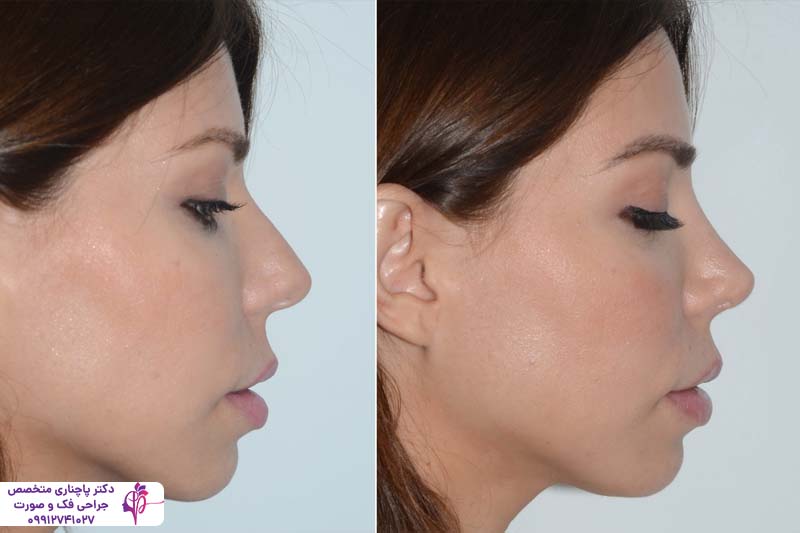 رینوپلاستی به روش اولتراسونیک