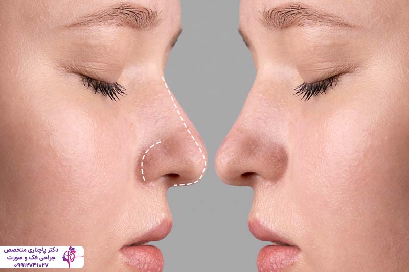 جراحی رینوپلاستی ترمیمی
