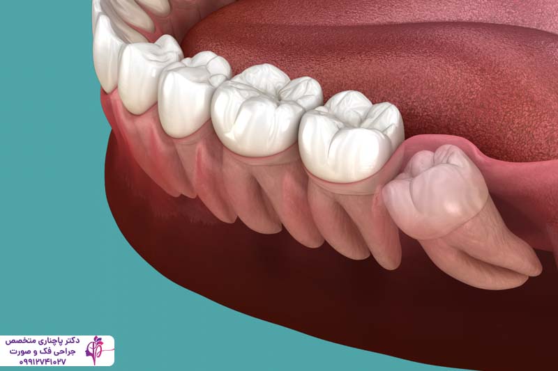 عوارض نکشیدن دندان عقل