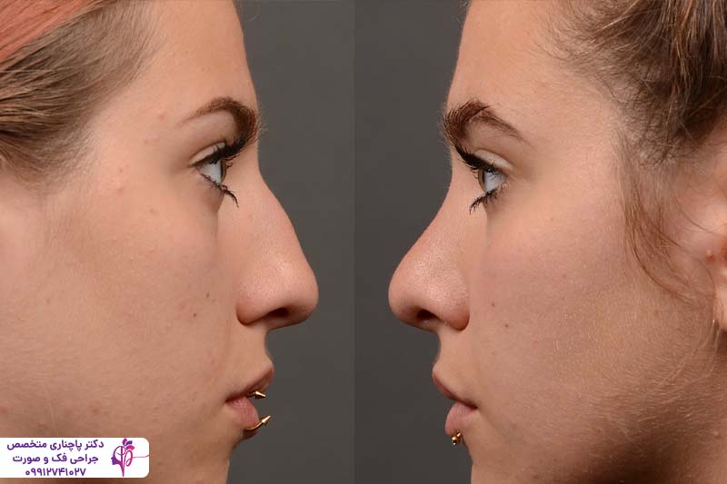 رینوپلاستی به روش اولتراسونیک