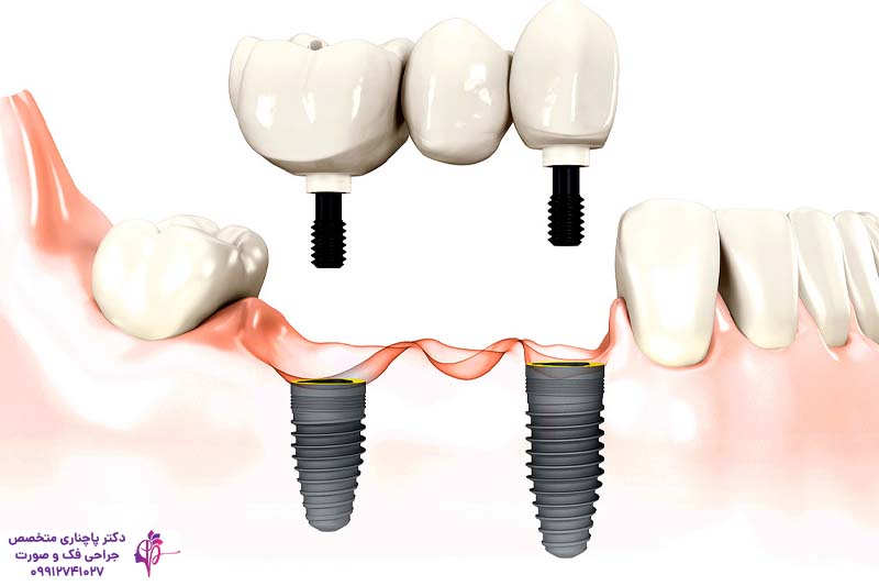 کاشت مجدد ایمپلنت دندان