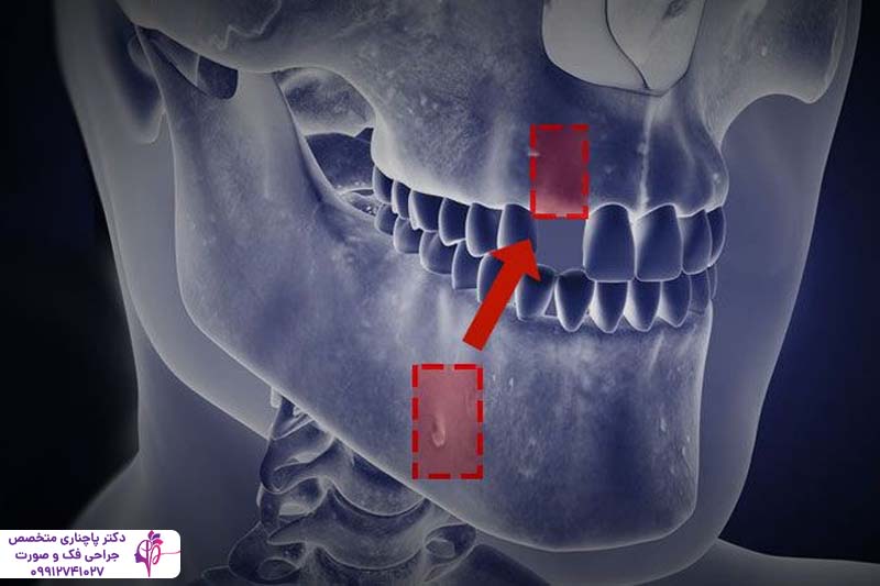 ورم صورت بعد از پیوند استخوان
