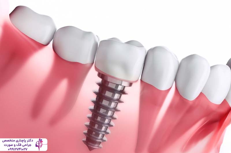 کاشت مجدد ایمپلنت دندان