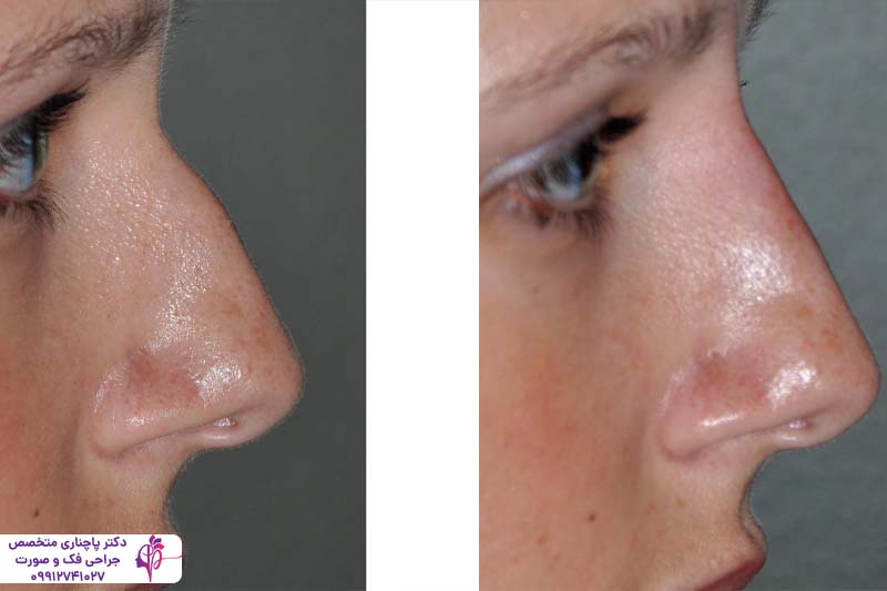 رینوپلاستی به روش اولتراسونیک