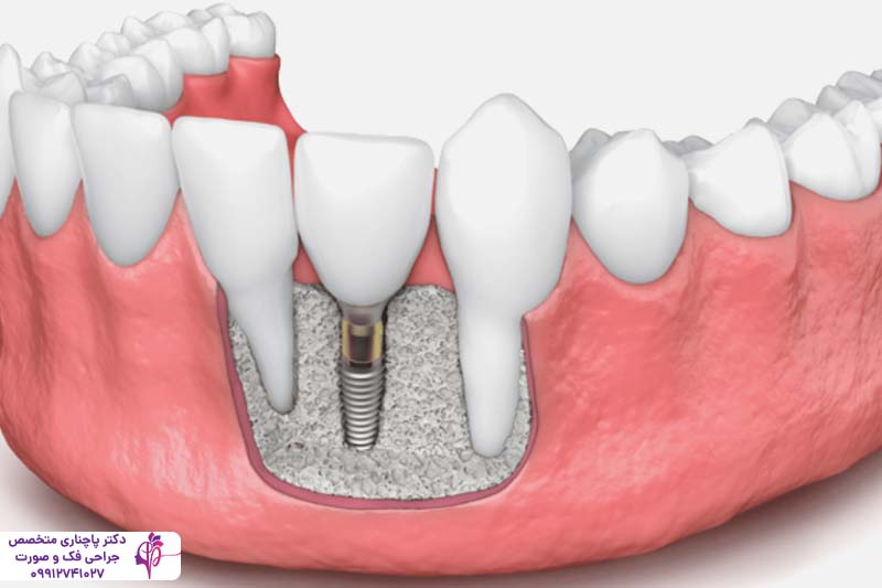 کاشت مجدد ایمپلنت دندان