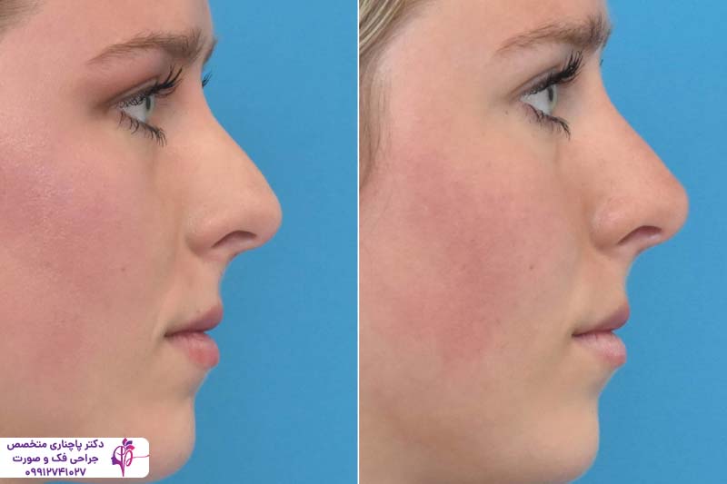 آزمایشات ضروری قبل از عمل بینی