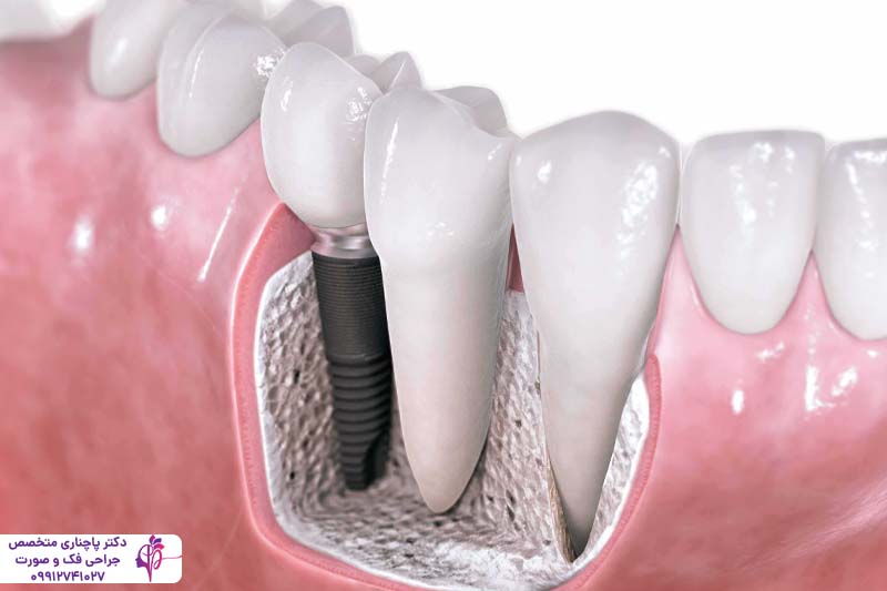 کاشت مجدد ایمپلنت دندان