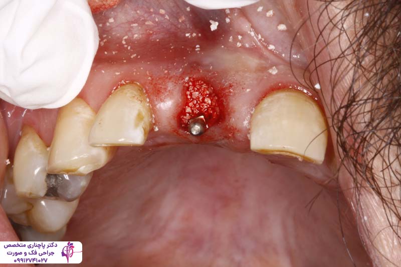 ورم صورت بعد از پیوند استخوان