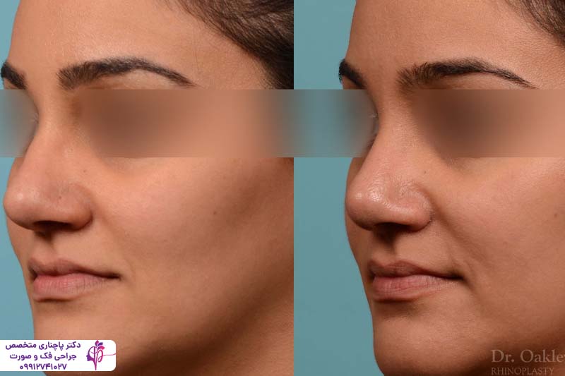 آزمایشات ضروری قبل از عمل بینی