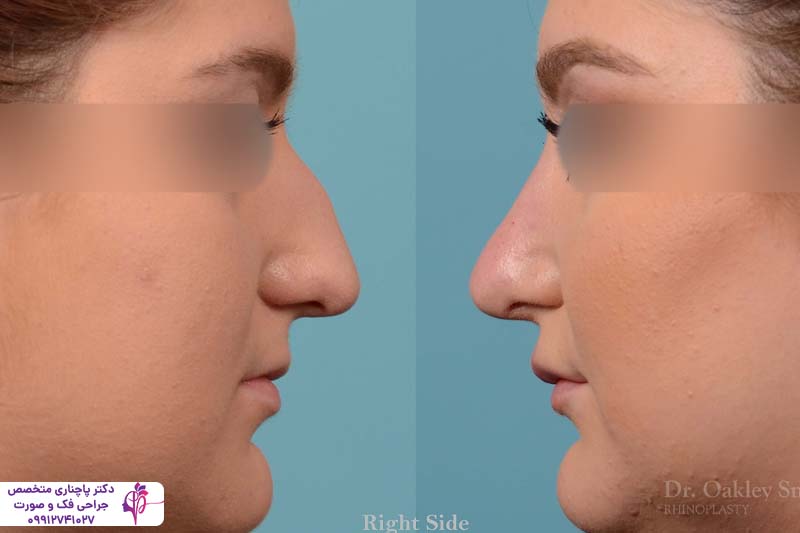 رینوپلاستی به روش اولتراسونیک