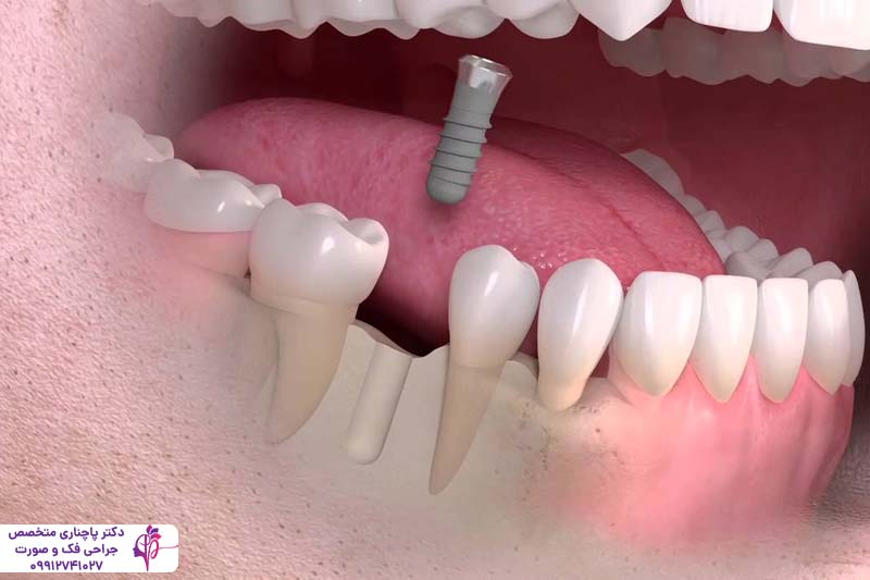 کاشت مجدد ایمپلنت دندان