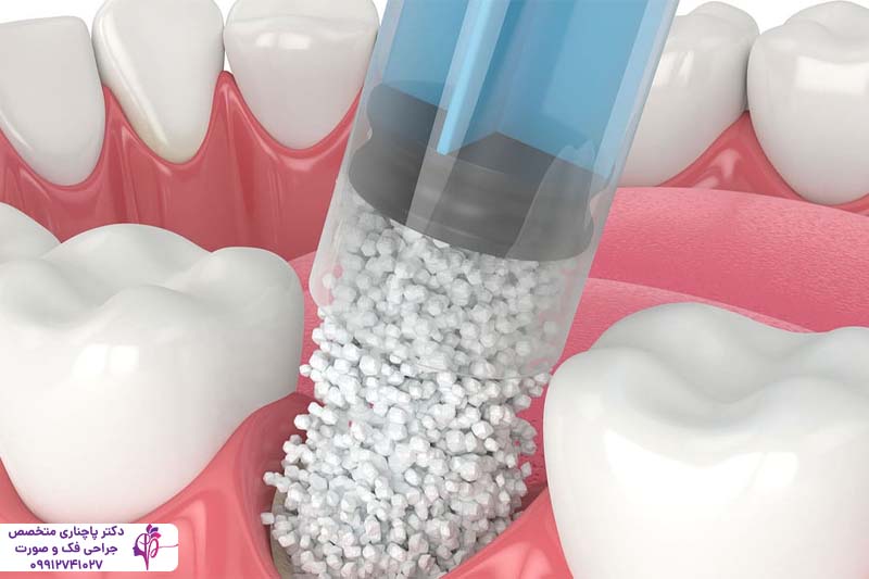 ورم صورت بعد از پیوند استخوان