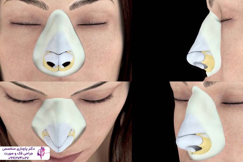 رینوپلاستی به روش اولتراسونیک