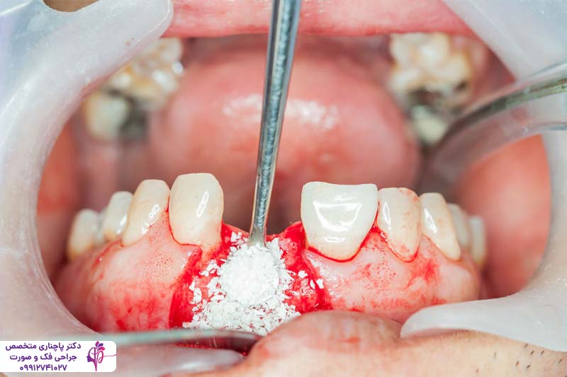 ورم صورت بعد از پیوند استخوان