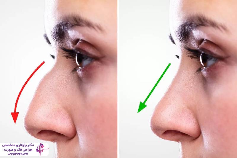 اصلاح قوز بینی