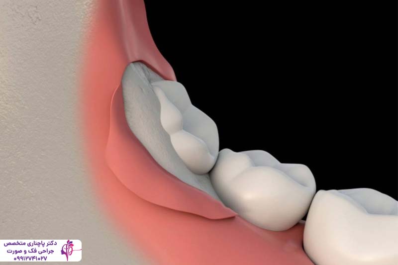 کشیدن دندان عقل