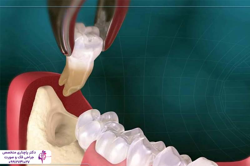 مزایا و معایب کشیدن دندان عقل