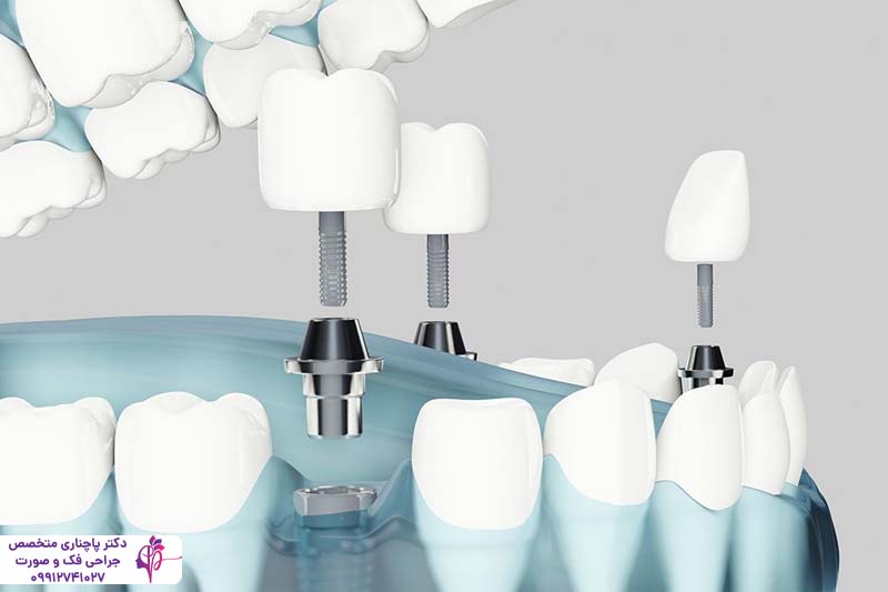 ایمپلنت آمریکایی زیمر Zimmer