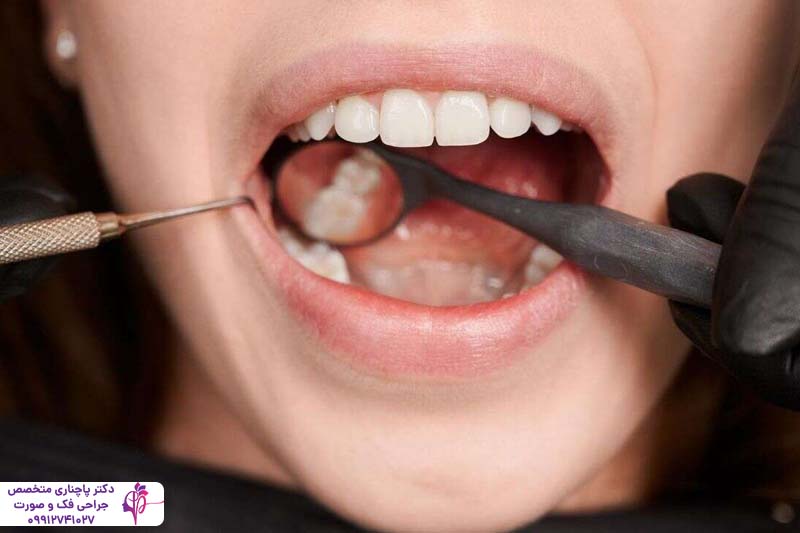 کشیدن دندان عقل