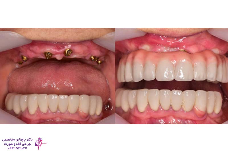 جراحی لثه برای ایمپلنت
