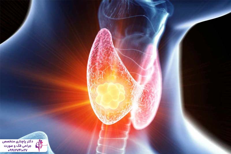 ایمپلنت دندان بیماران تیروئیدی