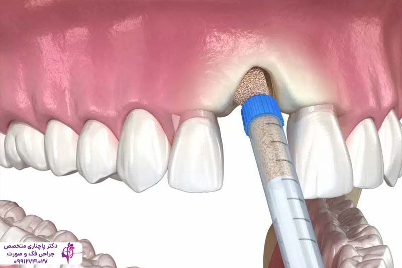 هزینه پیوند استخوان برای ایمپلنت