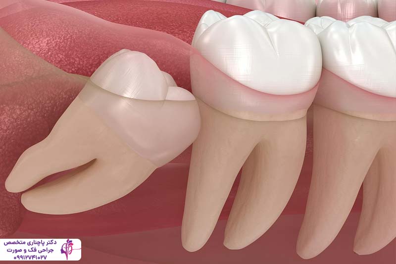 مزایا و معایب کشیدن دندان عقل