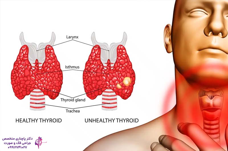 ایمپلنت دندان بیماران تیروئیدی