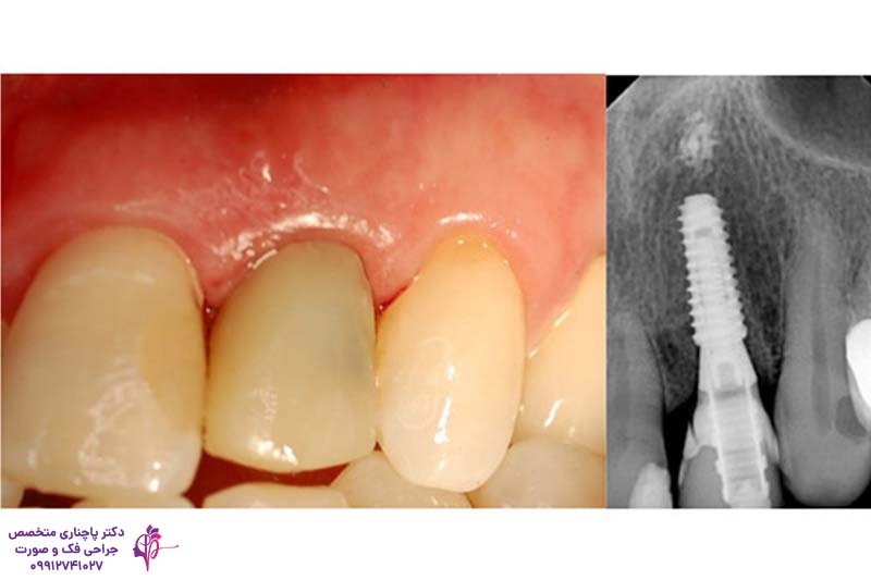 ایمپلنت و روکش دندان لترال