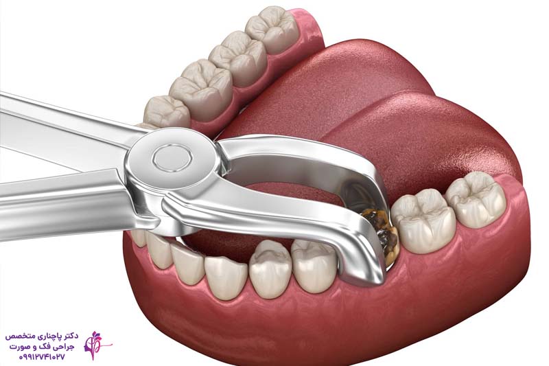 کشیدن دندان عقل