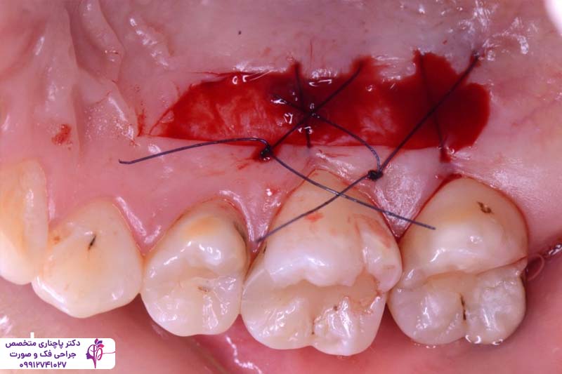 جراحی لثه برای ایمپلنت