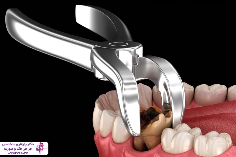 مزایا و معایب کشیدن دندان عقل