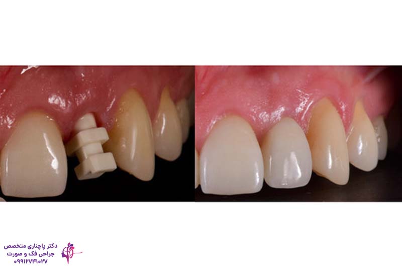 ایمپلنت و روکش دندان لترال