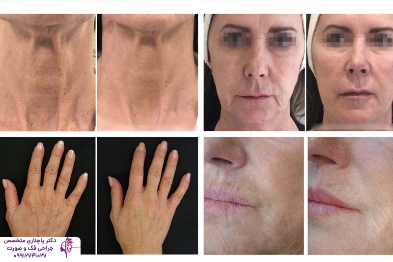 مراقبت‌های بعد از تزریق پروفایلو