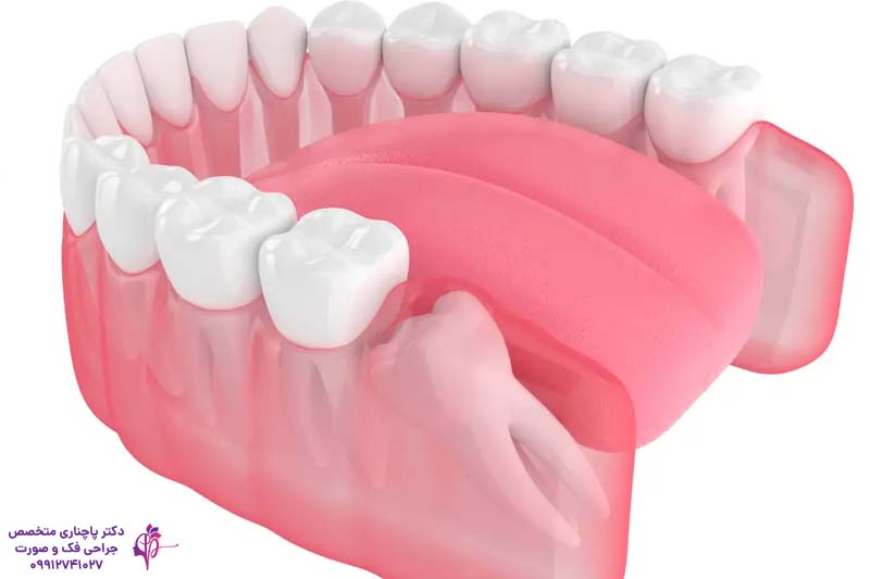 کشیدن دندان عقل