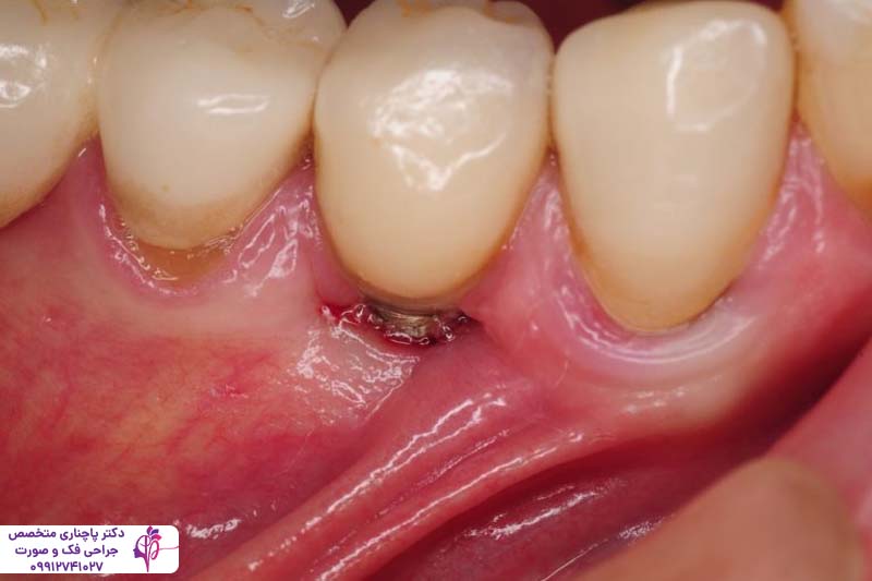 جراحی لثه برای ایمپلنت