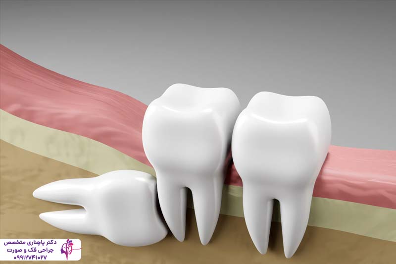 مزایا و معایب کشیدن دندان عقل