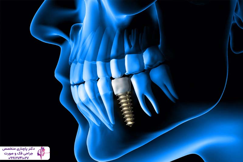 ایمپلنت دندان بیماران تیروئیدی