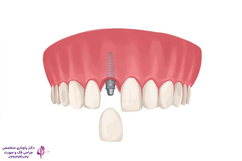 ایمپلنت و روکش دندان لترال