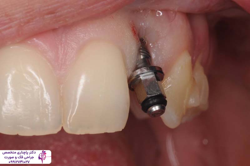 جراحی لثه برای ایمپلنت