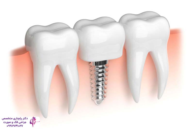 ایمپلنت آمریکایی زیمر Zimmer