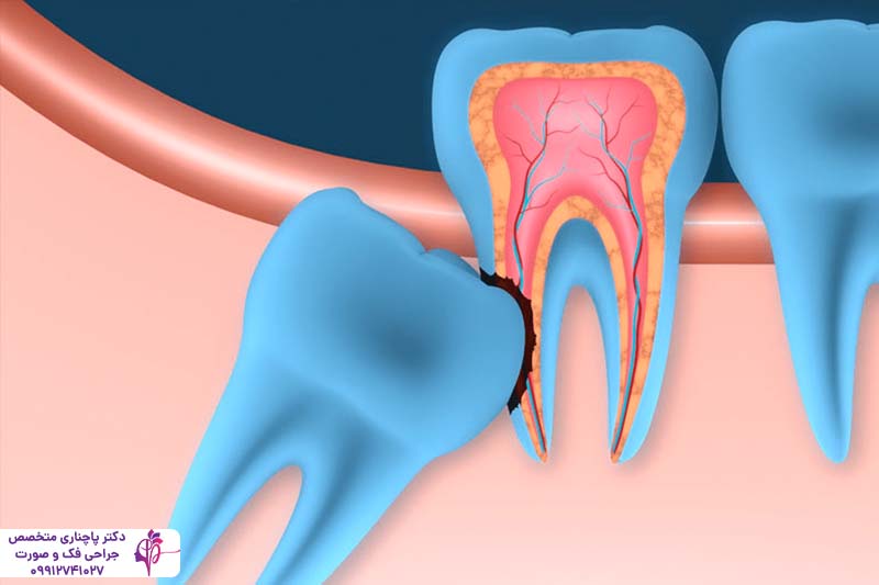 کشیدن دندان عقل