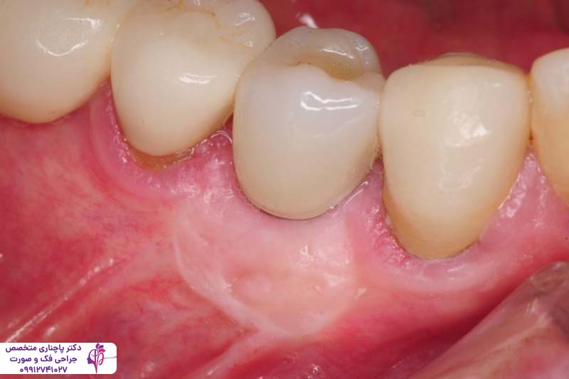 جراحی لثه برای ایمپلنت