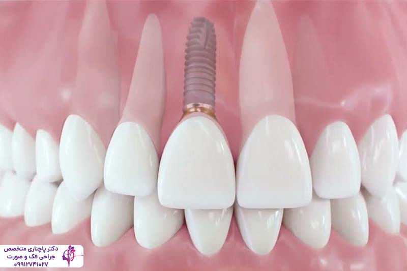 ایمپلنت دندان بیماران تیروئیدی