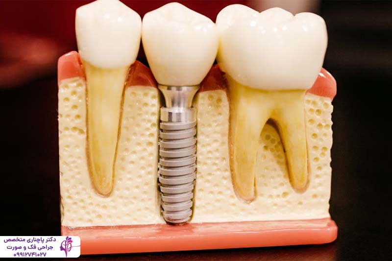 ایمپلنت آمریکایی زیمر Zimmer