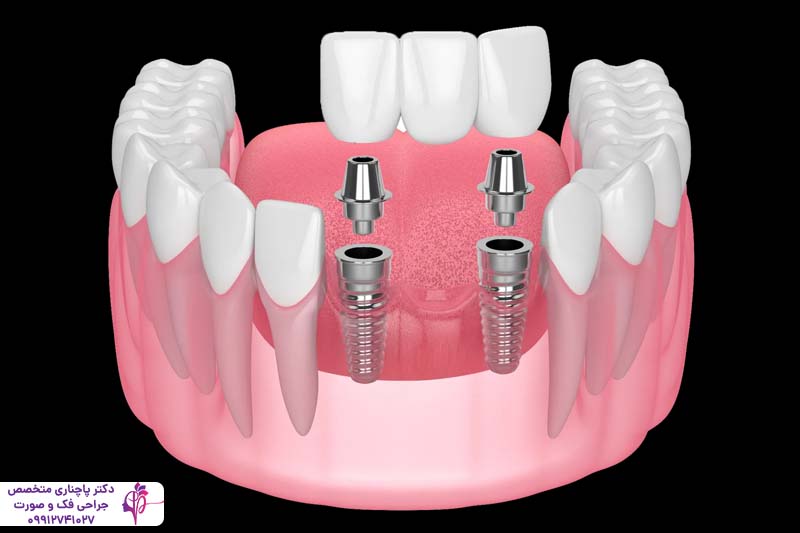 ایمپلنت و روکش دندان لترال